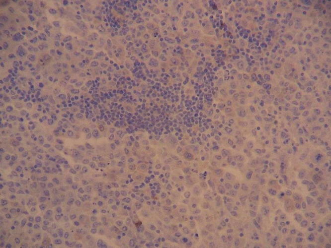 Fig. 15 - CD56 es completamente negativo.